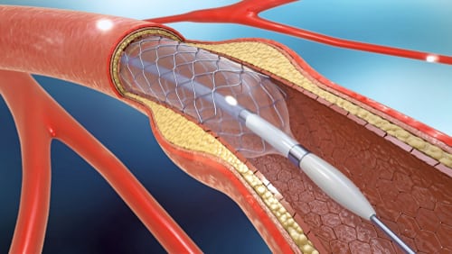 Peripheral Artery Disease Treatment | Santa Maria & SLO